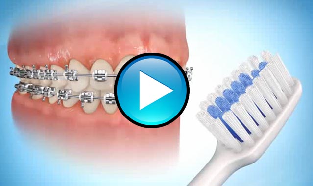 Brushing Techniques with Braces