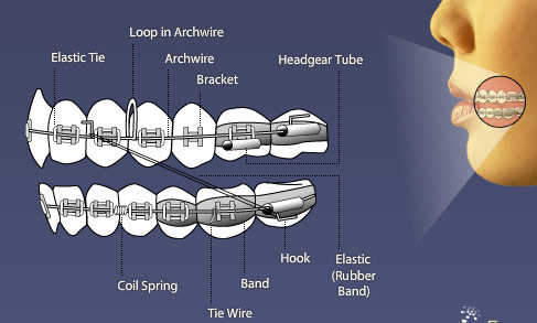 braces-diagram