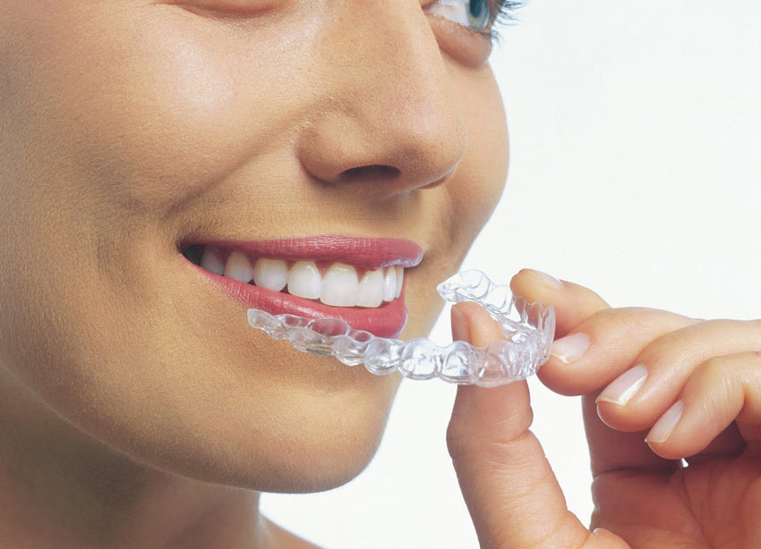 How Much Does Invisalign Cost? - Orthodontic Center of SVC