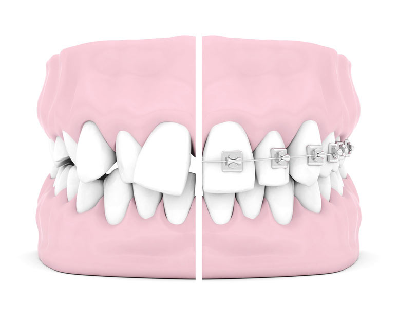 Self-Ligating Braces - Stoneham Malden MA