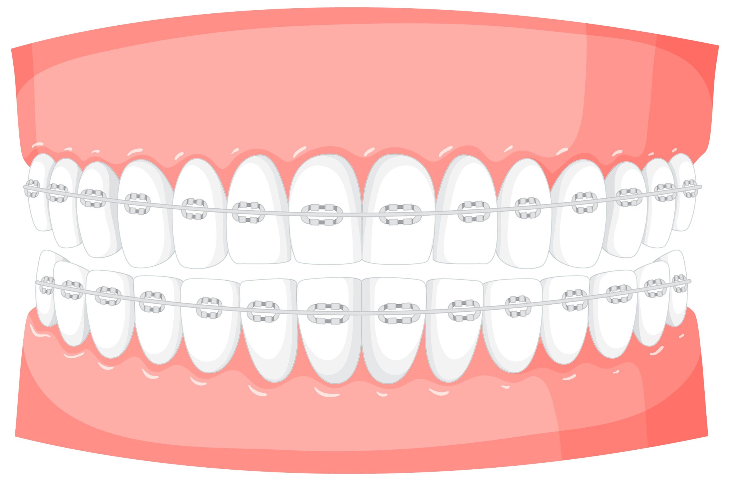 why-braces